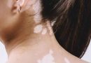 सफेद दाग (Leucoderma) – कारण और उपचार पर एक विस्तृत चिकित्सा विश्लेषण