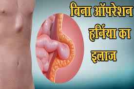 Hernia_