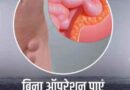 ऑपरेशन के बिना 100% ठीक करें हर्निया (Hernia)