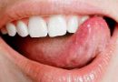 मुंह का आना (Mouth Sores)- Symptoms, Treatment, And Prevention