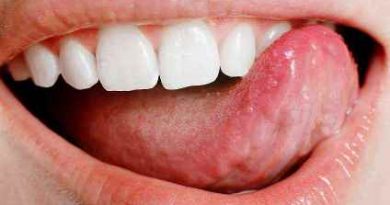 मुंह का आना (Mouth Sores)- Symptoms, Treatment, And Prevention
