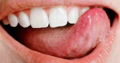 Mouth Sores