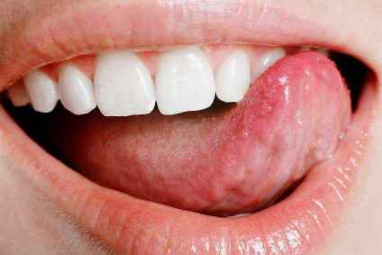 मुंह का आना (Mouth Sores)- Symptoms, Treatment, And Prevention