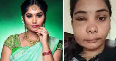 Kannada Actress Swati Sathish ने कराई रूट कैनल सर्जरी, बिगड़ गया पूरा चेहरा