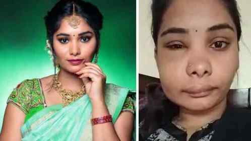Kannada Actress Swati Sathish ने कराई रूट कैनल सर्जरी, बिगड़ गया पूरा चेहरा Kannada Actress Swati Sathish ने कराई रूट कैनल सर्जरी, बिगड़ गया पूरा चेहरा