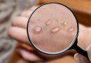Monkeypox