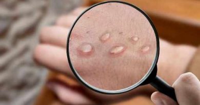 भारत में अब तक Monkeypox के नौ मामले सामने आए, ए.2 से संक्रमित थे दो- Report