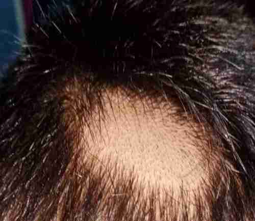 Almora में स्कूली बच्चों के साथ अमानवीय व्यवहार: एक दर्जन बच्चों के सिर पर रेजर लगाकर काट दिए बाल