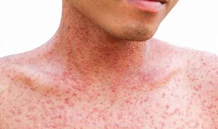 बेहद संक्रामक होती है Khasra (Measles)