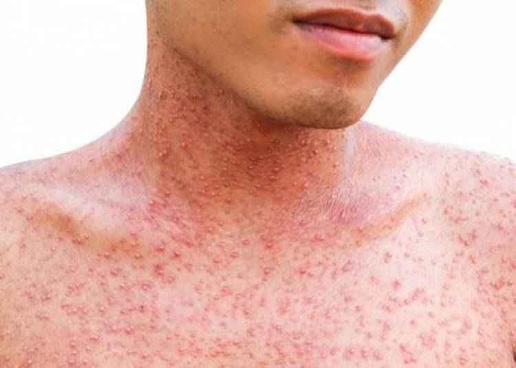 बेहद संक्रामक होती है Khasra (Measles) बेहद संक्रामक होती है Khasra (Measles)
