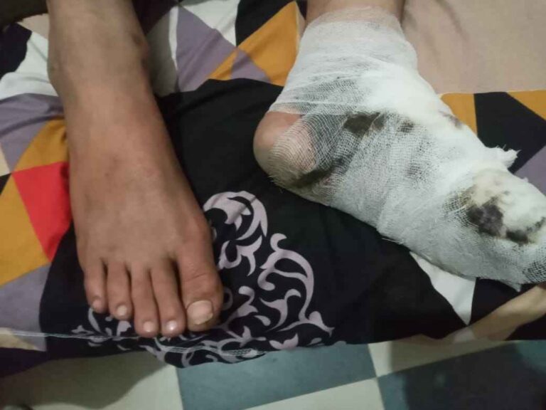 Khatauli News: चीनी मिल से निकलने वाली राख लगातार लोगों की जान की दुश्मन, किशोर झुलसा