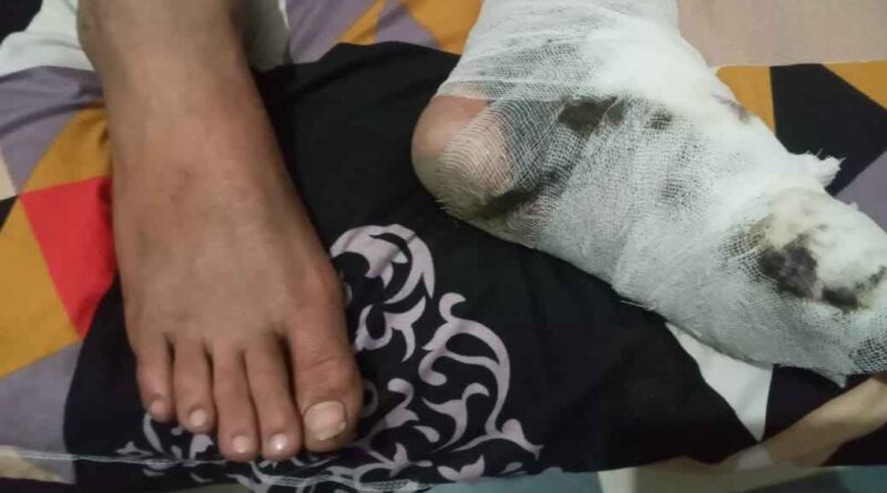 Khatauli News: चीनी मिल से निकलने वाली राख लगातार लोगों की जान की दुश्मन, किशोर झुलसा