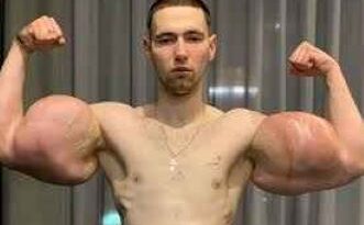 Kirill Tereshin: जिम के जुनून में हाथों में इंजेक्ट कर लिया वैसलिन?