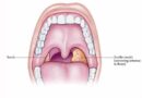 Tonsillitis