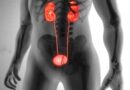 Kidney Stone