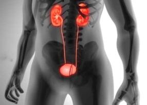 Kidney Stone