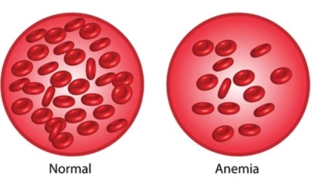 Anemia Symptoms Hemoglobin