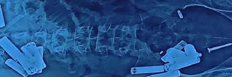 Hathras के आदित्य की रहस्यमयी मौत: पेट में मिले 56 अजीब सामान ने बढ़ाई चिंता