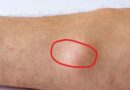 Lipoma (चर्बी की गांठ) का इलाज, कारण और घरेलू नुस्खे: बिना सर्जरी के पाएं राहत